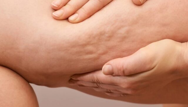 Zabiegi na cellulit - Szczecin