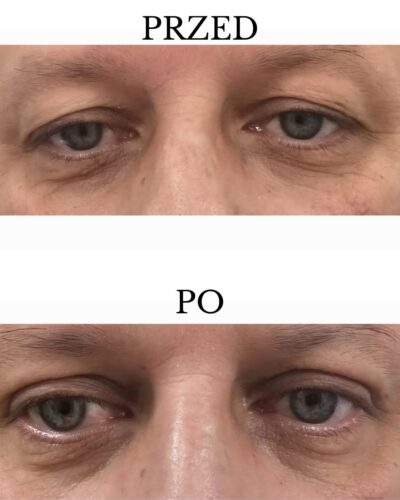efekty zabiegu blefaroplastyki
